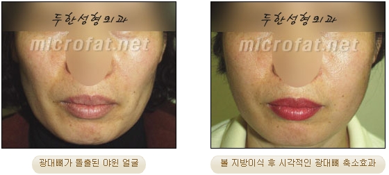 얼굴지방이식 두한성형외과 - 볼지방이식 관련 이미지 17