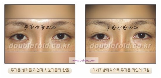 [두한성형외과 경쟁력 눈성형] - [쌍꺼풀 재수술에 대한 최선의 대안 제시] 관련 이미지 21