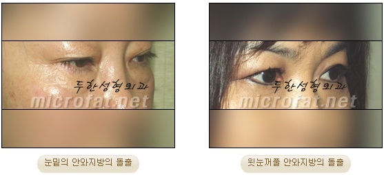 [두한성형외과 지방제거] - [눈밑지방제거, 윗눈꺼풀지방제거] 관련 이미지 1
