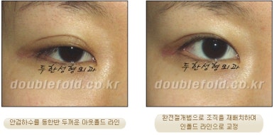 [두한성형외과 쌍커풀재수술] - [심한 소세지눈, 두줄따기, 쌍꺼풀 흉터] 관련 이미지 22