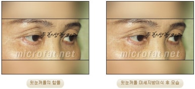 [Doohan Plastic Surgery Autologous Fat Grafting] - [Sunken Eye Fat Grafting] image 24