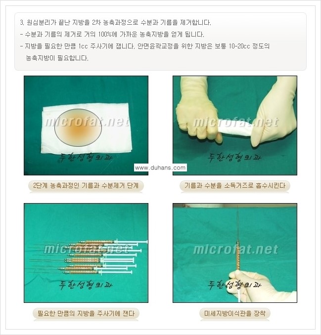 [두한성형외과 경쟁력 미세지방이식] - [타병원에서의 미세지방이식 부작용 교정 방법 안내] 관련 이미지 9