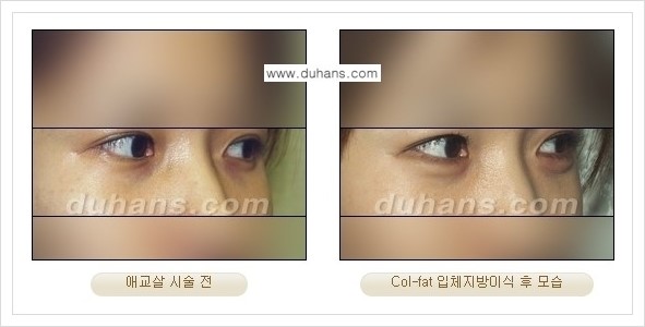 [두한성형외과 경쟁력 미세지방이식] - [지방이식 특허 Col-fat 미세지방이식 성공사례 안내] 관련 이미지 7