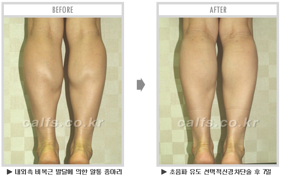 [종아리성형 두한성형외과] - [종아리수술에 대한 자주하는 질문과 답변 모음] 관련 이미지 54