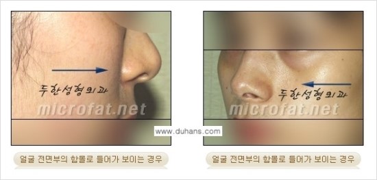 [두한성형외과 경쟁력 귀족성형] - [3차원 입체 미세지방이식 귀족수술 + 인디언밴드 교정] 관련 이미지 3