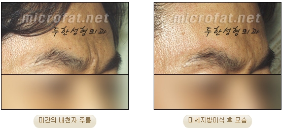 [두한성형외과 자가지방이식] - [미간주름] 관련 이미지 23