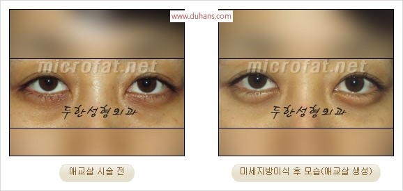 ​﻿[두한성형외과 경쟁력 지방이식] - [눈밑 애교살 시술을 위한 미세지방이식] 관련 이미지 35