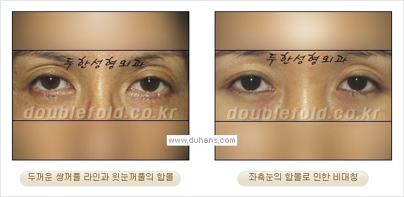 ​⁠⁠[두한성형외과 경쟁력 쌍꺼풀 재수술, 극한 눈재수술] - [지방이식으로 눈매와 쌍꺼풀 라인을 교정] 관련 이미지 1