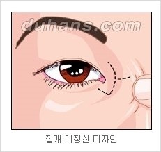쌍커풀수술 두한성형외과 - 나에게 맞는 눈성형은? 관련 이미지 53