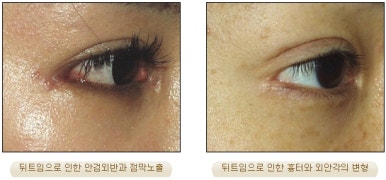 [Duhan Plastic Surgery Eyelid Surgery] - [Epicanthoplasty, Medial Canthoplasty] image 23