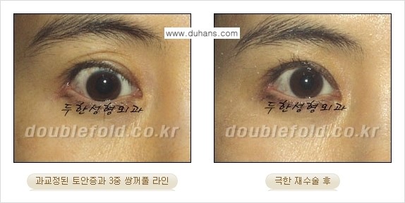 [두한성형외과 경쟁력 눈성형] - [극한의 상태에서 쌍꺼풀재수술(눈재수술) 안내] 관련 이미지 13