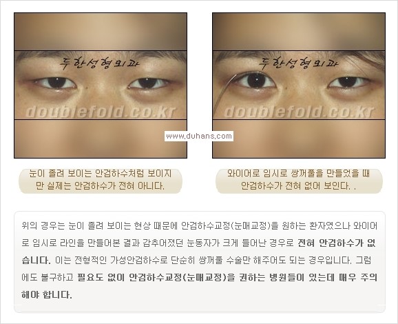 [두한성형외과 경쟁력 쌍꺼풀 재수술, 극한 눈재수술] - [안검하수 종류 안내] 관련 이미지 5