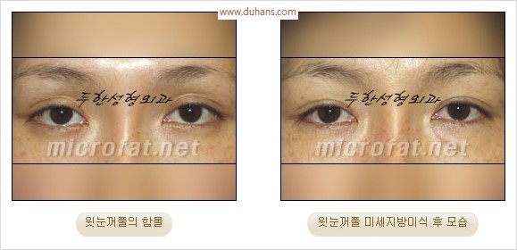 [두한성형외과 경쟁력 눈성형 리더] - [윗눈꺼풀 함몰( #꺼진눈꺼풀) 미세지방이식과 상안검성형]#꺼진눈성형 , #눈위함몰 관련 이미지 16