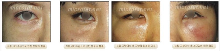 [Duhan Plastic Surgery Face Fat Grafting] - [Reducing Mouth Corners Wrinkles and Nasolabial Folds] image 23
