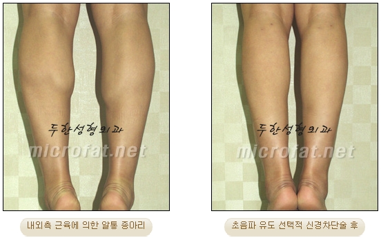[Duhan Plastic Surgery Clinic Calf Contouring] - [Calf Reduction] image 21