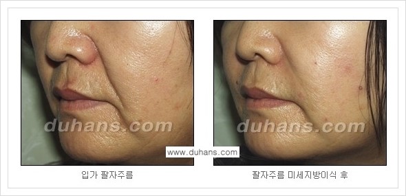 [두한성형외과 경쟁력 주름성형] - [코 옆과 입가에 걸쳐서 형성된 주름을 교정해주는 미세지방이식] 관련 이미지 20