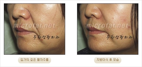 [두한성형외과 경쟁력 안티에이징 동안성형] - [주름이 깊은 푹~ 꺼진 입가 팔자주름 안녕!] 관련 이미지 18