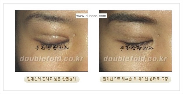 [두한성형외과 경쟁력 쌍꺼풀 재수술] - [잘못된 쌍꺼풀 재수술로 인한 넓어진 흉터 처리 교정 안내] 관련 이미지 1