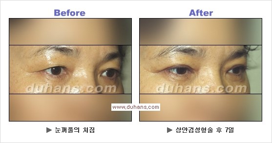 [두한성형외과 경쟁력 안검성형] - [젊고 아름다운 눈매 상안검 성형술 안내] 관련 이미지 11