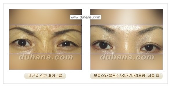 [두한성형외과 경쟁력 주름성형] - [미간주름, 눈가주름, 눈밑주름 제거 시술 안내] 관련 이미지 2