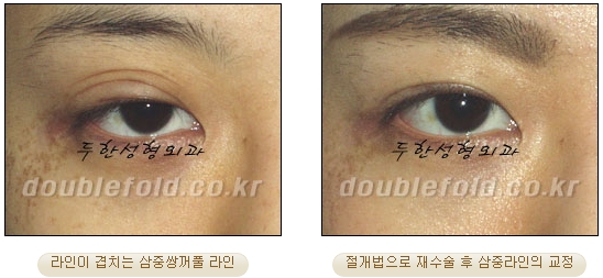 [두한성형외과 눈재수술] - [재수술 방법들] 관련 이미지 24