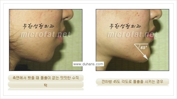 ⁠⁠[두한성형외과 경쟁력 미세지방이식] - [턱 미세지방이식 - 안면윤곽 교정 안내] 관련 이미지 6