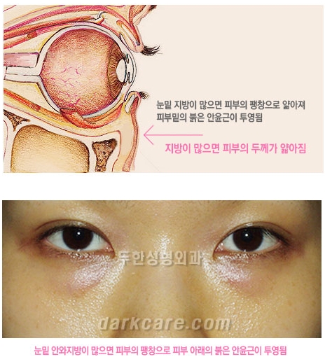 [두한성형외과 다크서클 수술방법] - [NO흉터 눈밑지방제거] 관련 이미지 4