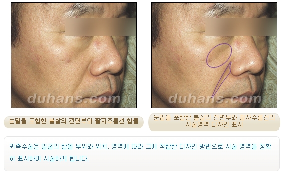 [두한성형외과 입체 미세지방이식] - [귀족수술] 관련 이미지 5