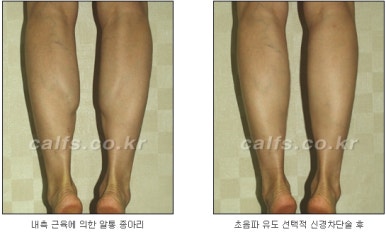 ​[두한성형외과 종아리수술] - [나에게 맞는 종아리성형방법] 관련 이미지 12