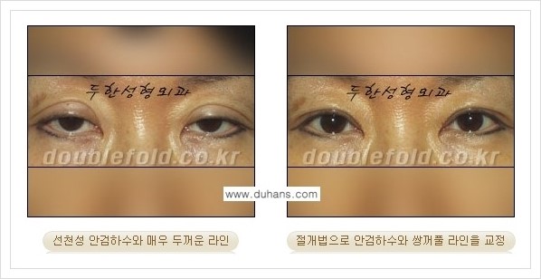 [두한성형외과 경쟁력 쌍꺼풀 재수술, 극한 눈 재수술] - [안검하수(졸리운 눈매) 재수술 안내] 관련 이미지 7