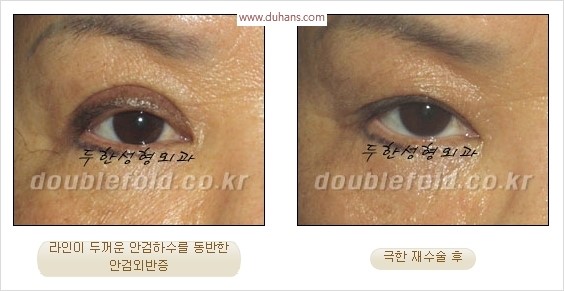 [두한성형외과 경쟁력 눈성형] - [극한 재수술, 함몰된 눈꺼풀 라인교정, 안검하수(졸리운 눈매)] 관련 이미지 11