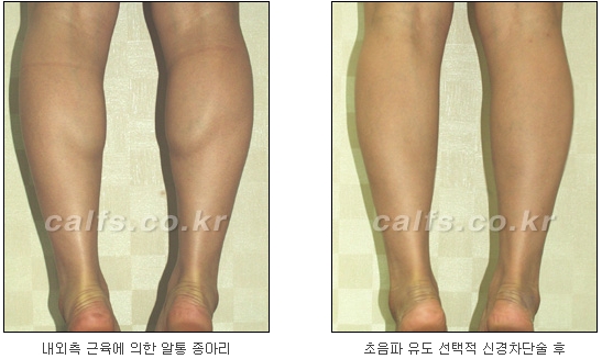 [두한성형외과 종아리퇴축술] - [NO절개! 초음파유도신경차단술] 관련 이미지 32