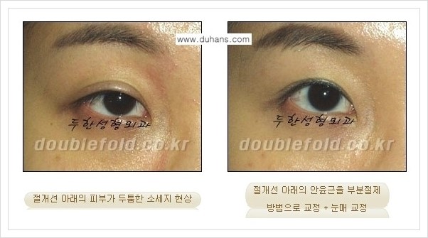 [두한성형외과 경쟁력 쌍꺼풀 재수술] - [절개선 아래가 두툼한 소세지 쌍꺼풀 안내] 관련 이미지 8