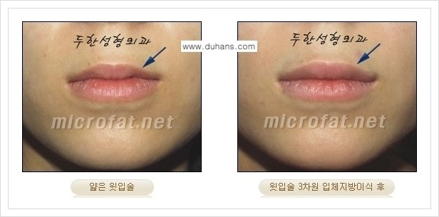[두한성형외과 경쟁력 미세지방이식] - [입술 미세지방이식 안내 2.] 관련 이미지 2