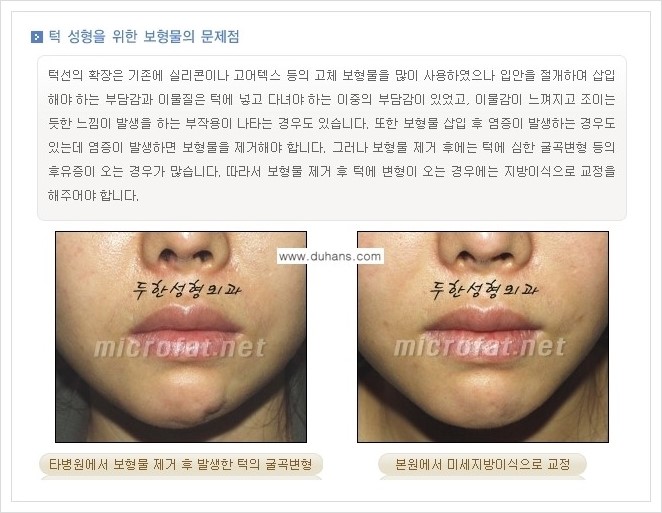 [두한성형외과의 경쟁력 미세지방이식] - [무턱교정, 턱 미세지방이식 안내 1.] 관련 이미지 7