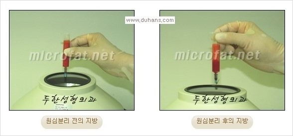 ​​​[두한성형외과 경쟁력 지방이식] - [지방이식을 이용한 입술성형 안내] 관련 이미지 5