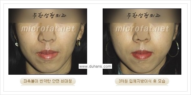 [두한성형외과 경쟁력 윤곽성형] - [볼, 볼살 지방이식] 관련 이미지 25