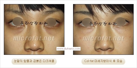 [두한성형외과 경쟁력 눈밑성형] - [눈밑이 전반적으로 함몰된 다크써클 교정 안내] 관련 이미지 8