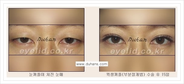 [두한성형외과 경쟁력 쌍꺼풀 재수술, 극한 재수술] - [퀵쌍꺼풀(부분절개법) 안내] 관련 이미지 4