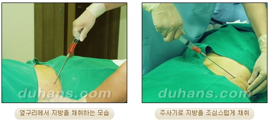 [Duhan Plastic Surgery Micro Fat Grafting] - [Receded Chin, Small Chin, Cleft Chin, Chin Line Asymmetry Correction] image 6