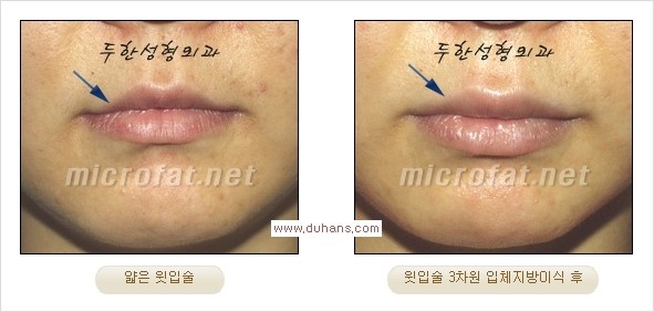 [두한성형외과 경쟁력 미세지방이식] - [입술 3차원 입체지방이식 안내 1.] 관련 이미지 8