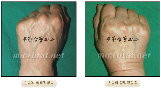 [Duhan Plastic Surgery Clinic Varicose Veins] - [Hand and Arm Venous Dilation] image 1
