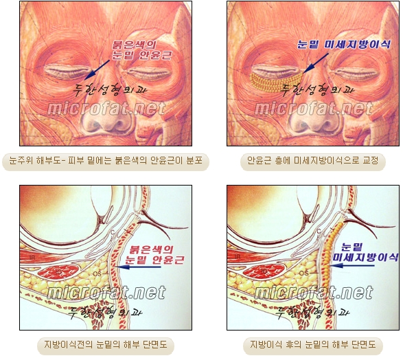 [두한성형외과 지방이식] - [다크서클, 눈밑주름] 관련 이미지 7