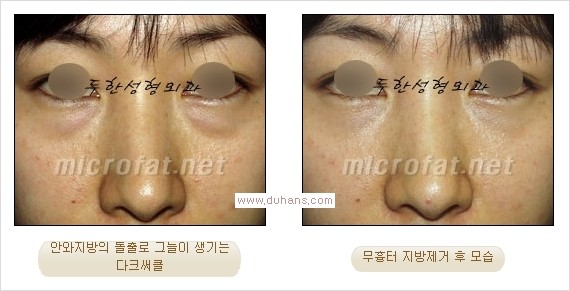 ⁠⁠[두한성형외과 경쟁력 안검성형] - [젊은 눈매를 위한 윗눈꺼풀 지방제거, 눈밑 지방제거] 관련 이미지 28