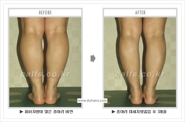 [두한성형외과 경쟁력 멀티종아리성형] - [종아리성형 방법별 전후 주의사항] 관련 이미지 28