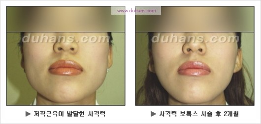 [두한성형외과 경쟁력 안면윤곽 성형 리더] - [완변한 V 라인! 턱 미세지방이식, 볼살 미세지방이식, 사각턱 보톡스 안내] 관련 이미지 36
