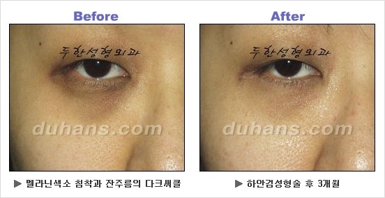 [두한성형외과 경쟁력 동안성형 리더] - ​[미간주름, 이마주름, 안검성형, 이마거상술, 눈썹거상술] 관련 이미지 108