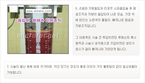 [두한성형외과 경쟁력 액취증, 다한증 치료] - [겨드랑이의 참기 힘든 냄새와 땀 치료 - 초음파 컷터지방흡입 + 리포셋 소파흡입술] 관련 이미지 19