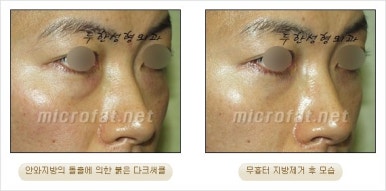 두한성형외과 눈밑수술 - 다크서클 수술 전후 관리 안내 관련 이미지 49