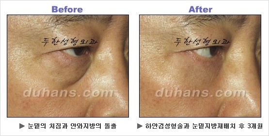 [두한성형외과 경쟁력 동안성형 리더] - ​[미간주름, 이마주름, 안검성형, 이마거상술, 눈썹거상술] 관련 이미지 109